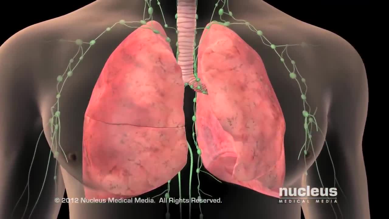 Avoiding Lung Cancer