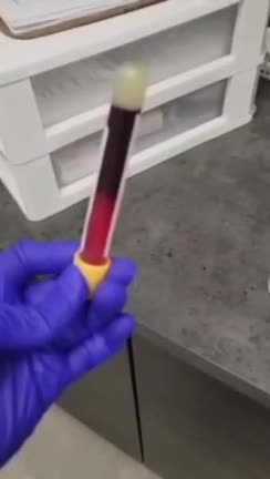 This blood taken from a "vaccinated" patient. After three minutes STARTED Clotting! It usually takes 30 minutes for blood to clot in an SST tube, not 3 minutes.