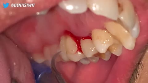 27 yo. Male's Teeth | Tartar Sticks To The Tooth Cavity | Dentist |