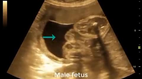 Baby in mother stomach complete video