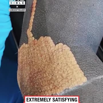 Extremely satisfying laser tattoo removal 😳