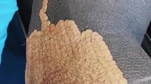 Extremely satisfying laser tattoo removal 😳