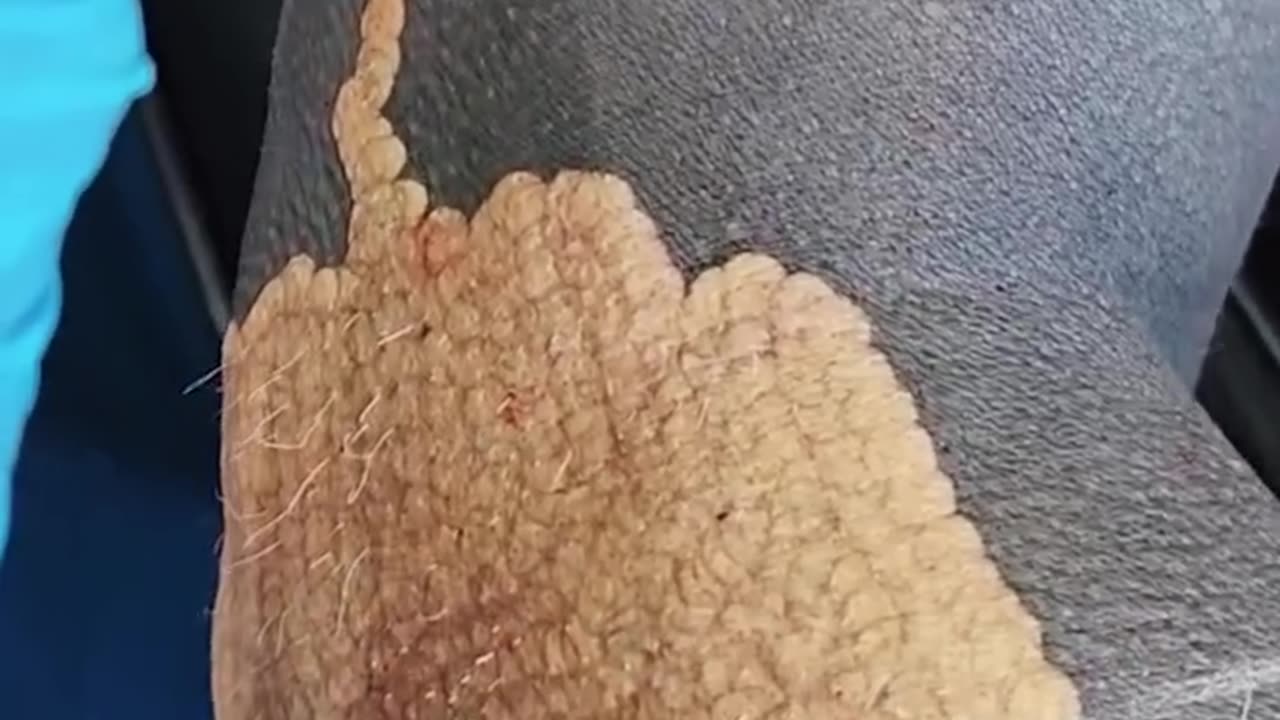 Extremely satisfying laser tattoo removal 😳