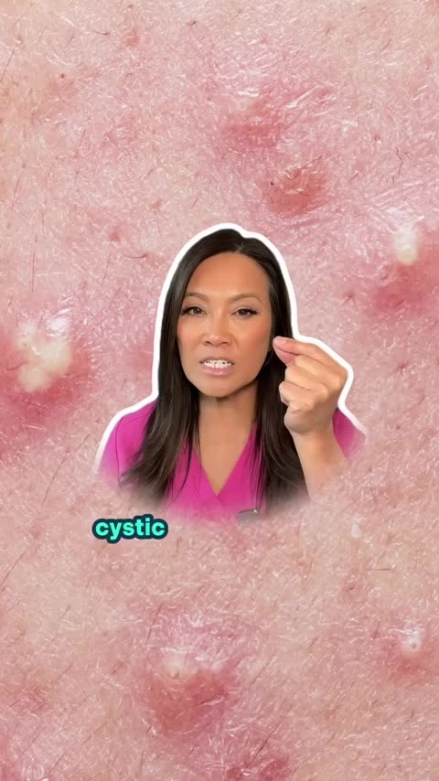 If you have mild to moderate acne and maybe don’t have easy access to a dermatologist...