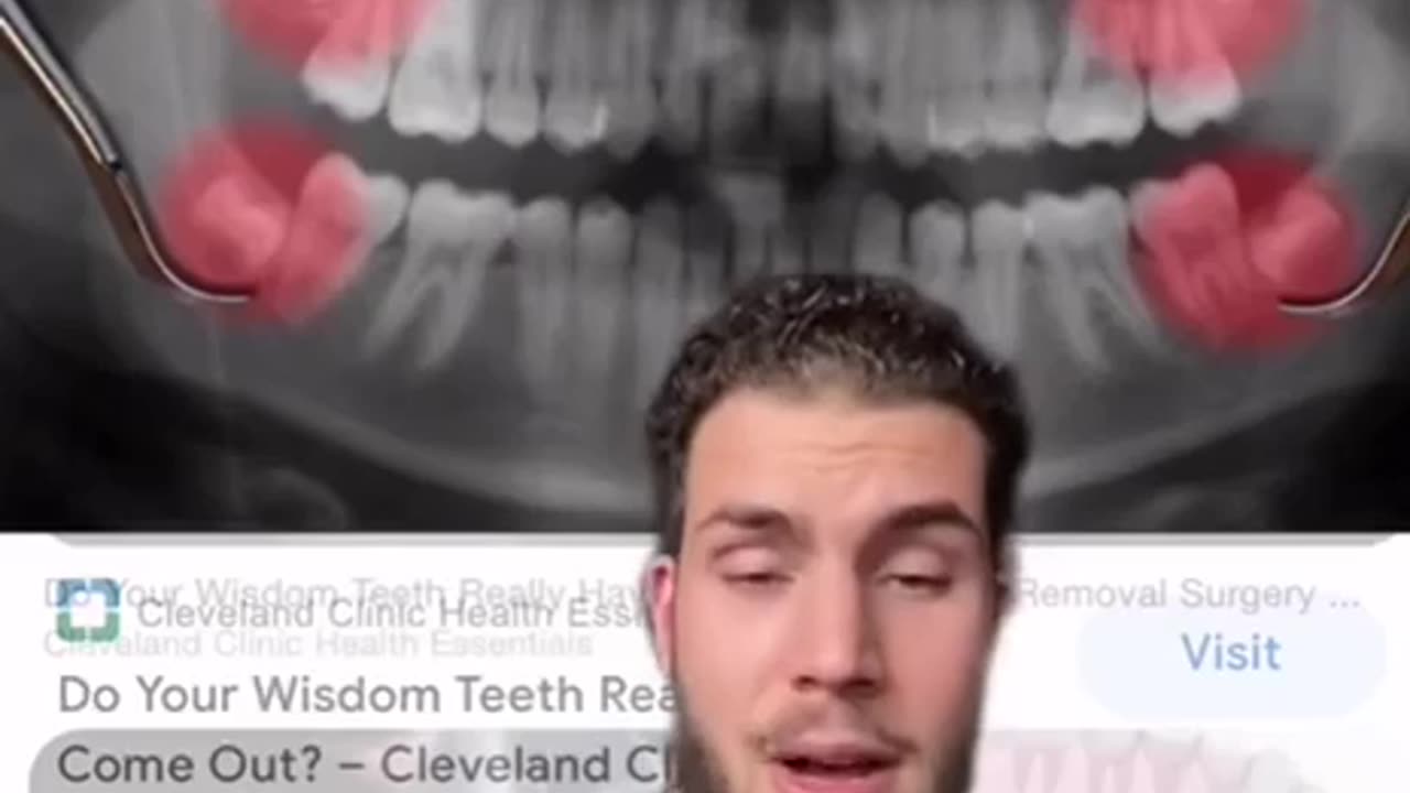 TRUTH ABOUT WISDOM TEETH REMOVAL..ROOT CANALS & THE PINEAL