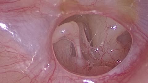 PhonoGraft Programming -the eardrum to repair itself