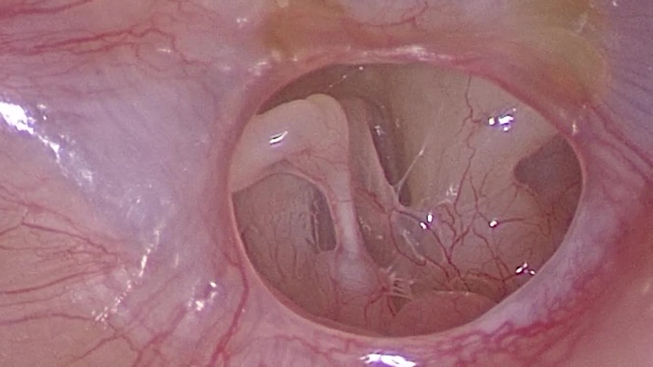 PhonoGraft Programming -the eardrum to repair itself