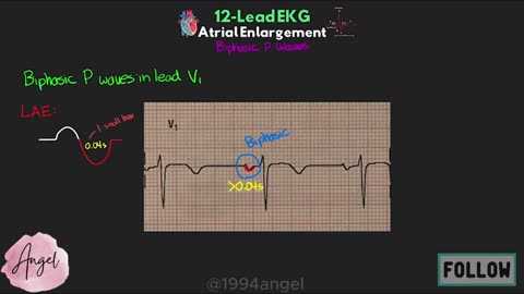 IDENTIFY Atrial Enlargement on 12-Lead EKG