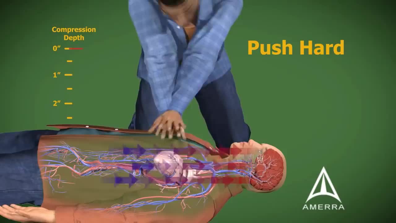 Cardiopulmonary Resuscitation (CPR) - 3D Medical Animation