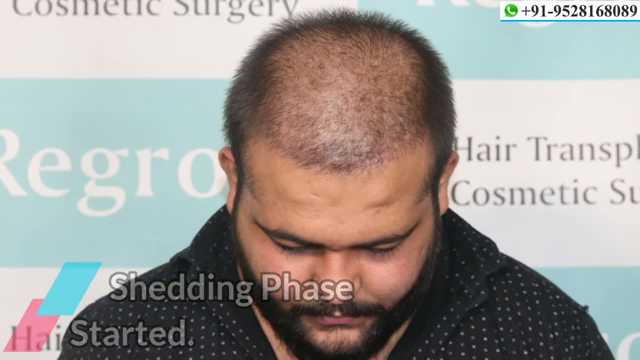 Best Hair Transplant results 2021