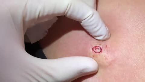 blackhead