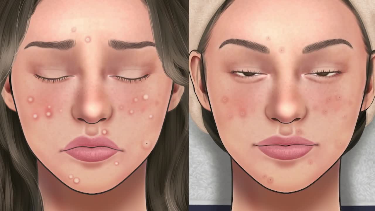 [AMSR]_Acne_Big_Blackhead_Removal_Ani_Motin