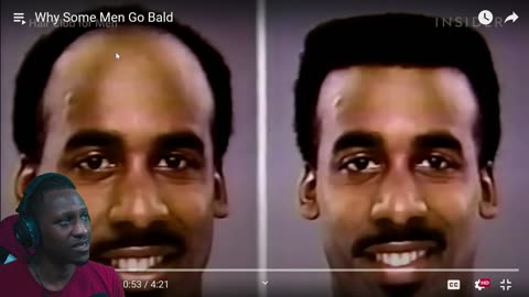 Why Some Men Go Bald