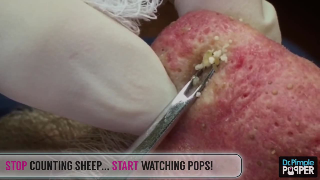 A Dr. Pimple Popper Bedtime Story - The Best Pops To Fall Asleep To - TRAILER