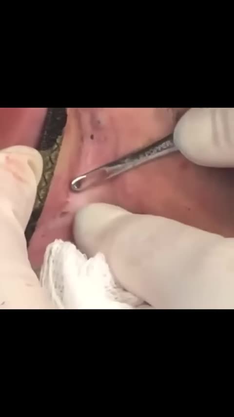 If you have mild to moderate acne and maybe don’t have easy access to a dermatologist