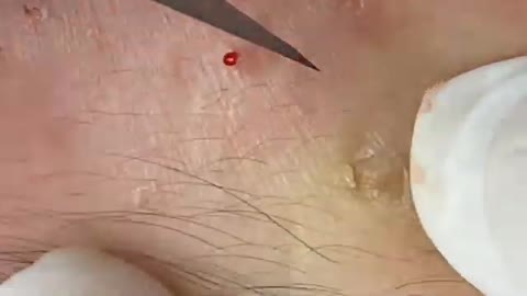 Milia & Hana Big Cystic Acne Blackheads Whiteheads Removal