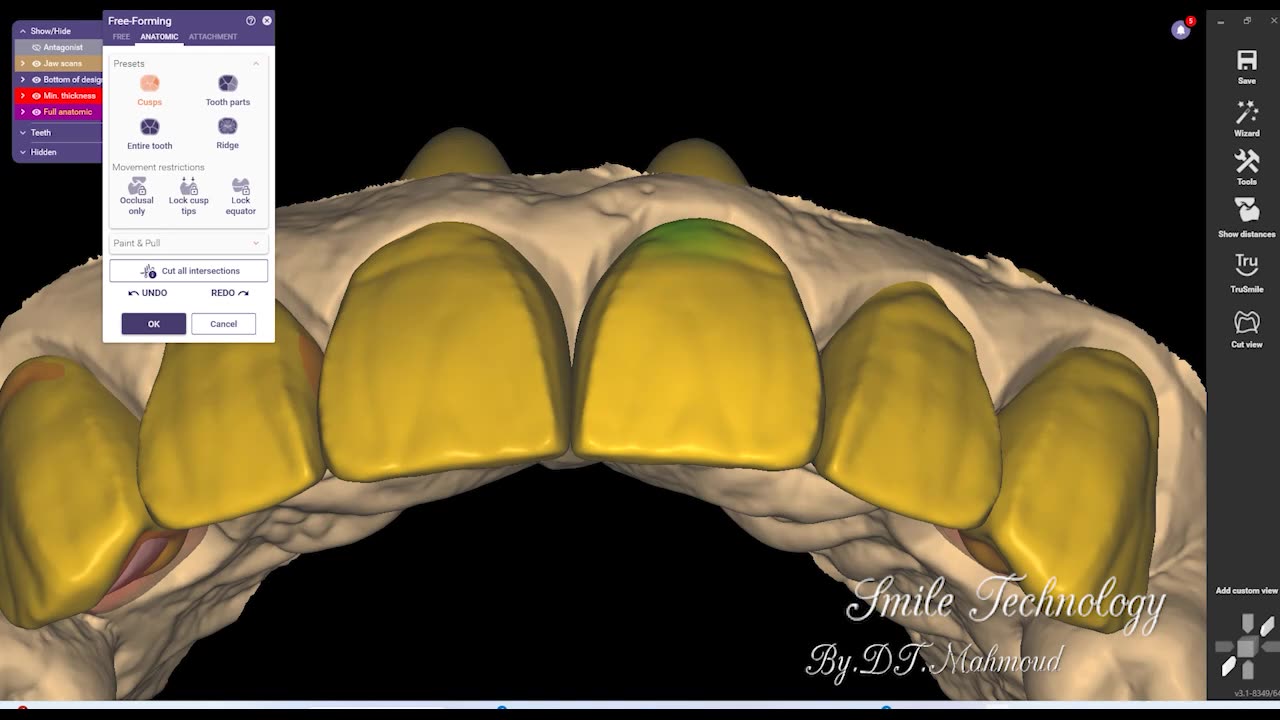 #design #naildesign #dental #dentaldesign #exocadexpert