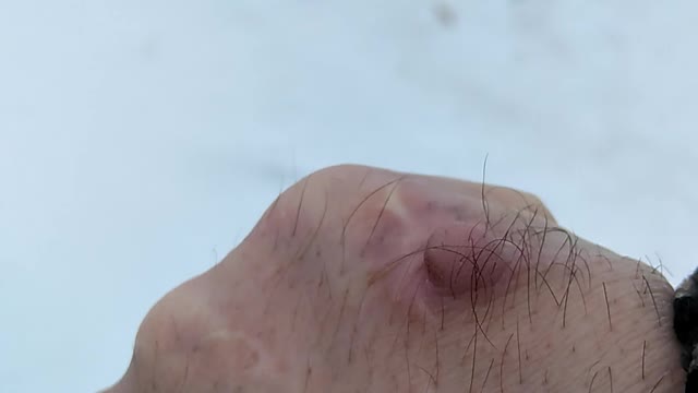 The consequences of a knife wound