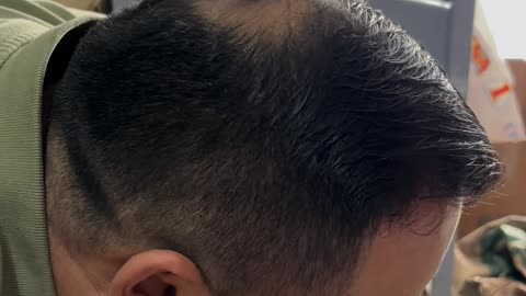 Top Spins On Balding Head