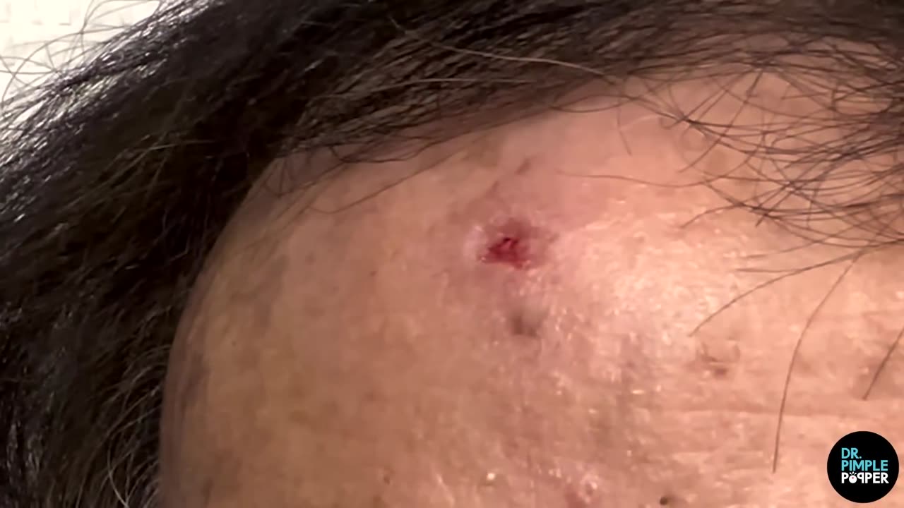 WHAT IS ON YOUR FOREHEAD？ Dr Pimple Popper Extracts Steatocystomas - Part 1