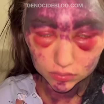 Alexis Lorenze suffering reactions from 3 vaccines administered