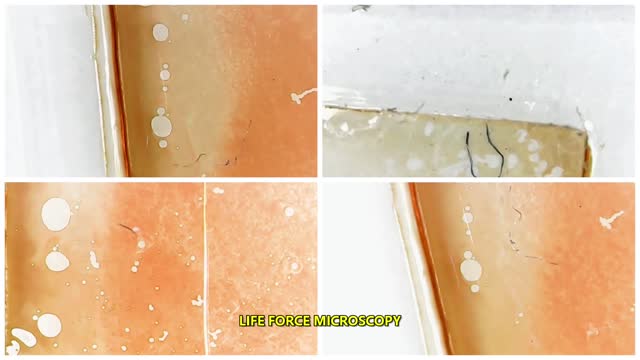 MORGELLONS? FILAMENTS AND FIBERS IN BLOOD (LIVE OR DRY)