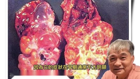 癌症來臨徵兆 疲倦、咳嗽別忽視