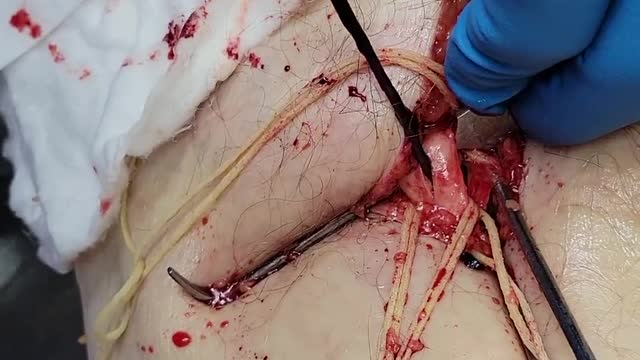 "This Is Not Normal" - Embalmer Richard Hirschman Releases Footage of Unbelievable Blood Clots