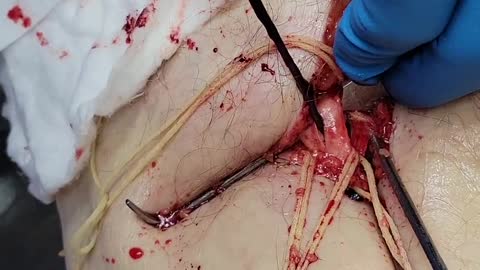 "This Is Not Normal" - Embalmer Richard Hirschman Releases Footage of Unbelievable Blood Clots