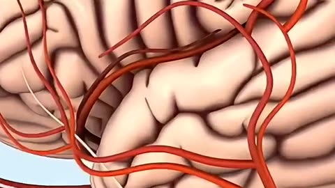Thrombectomy 🫣