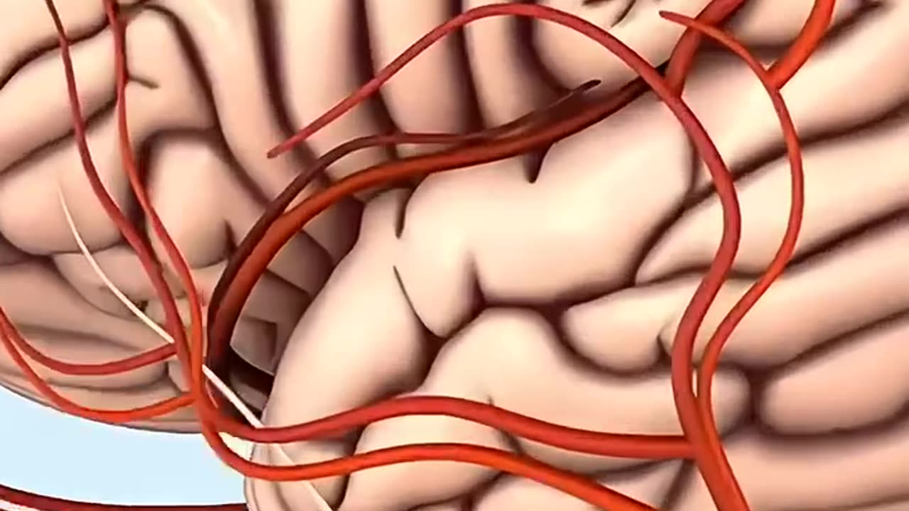 Thrombectomy 🫣