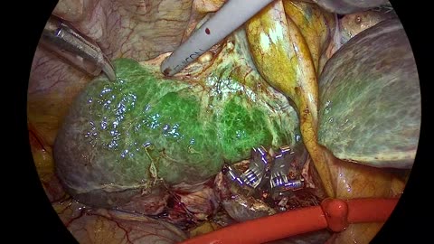 LIVER SURGERY FOR CANCER, (graphic content)