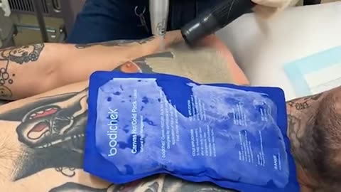 Removing tattoo with a laser