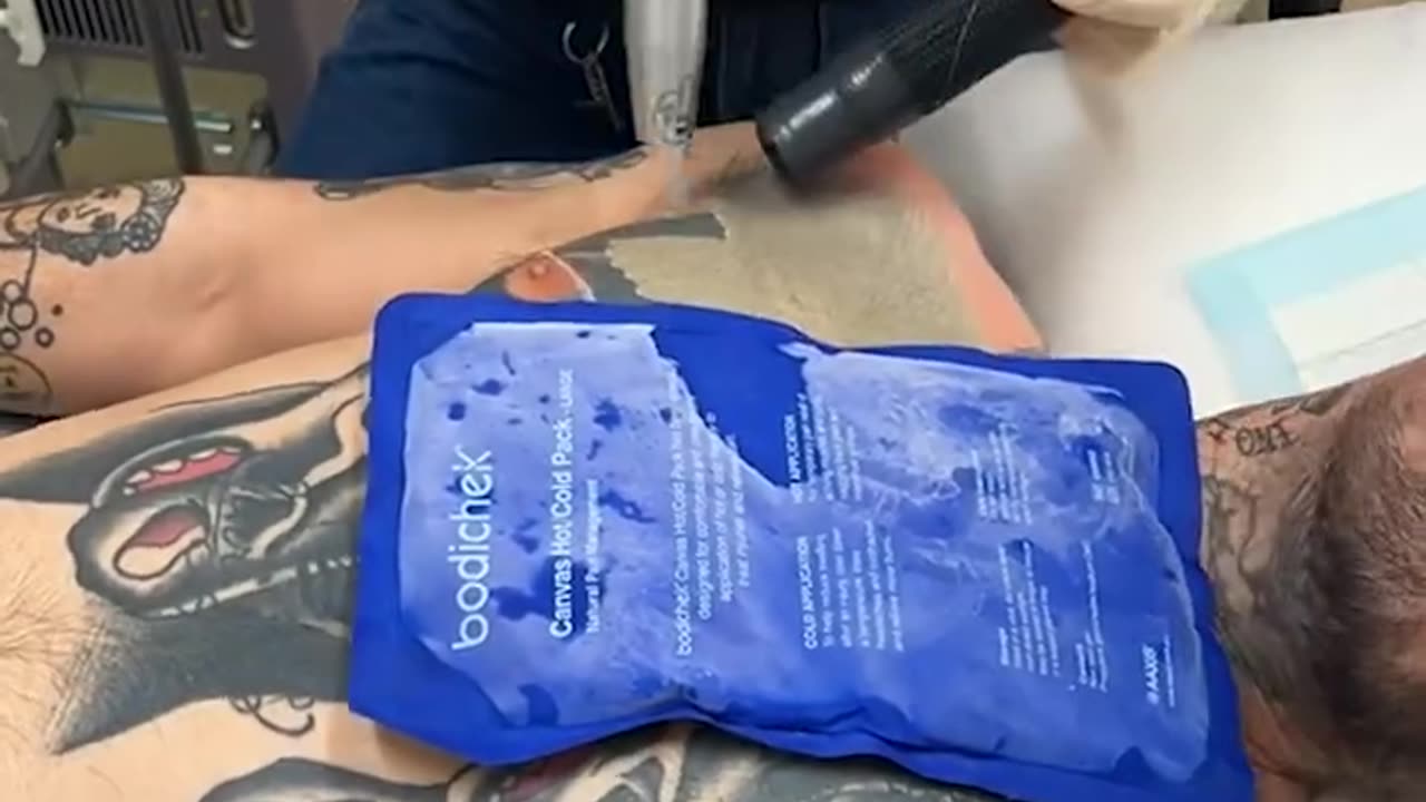 Removing tattoo with a laser