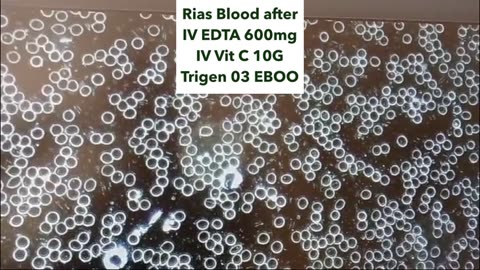 Hydrogel Clots - Why are we the only ones talking about this?