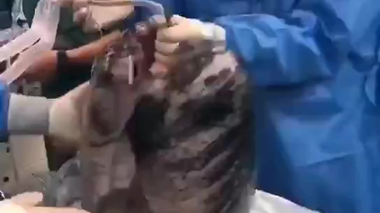 The blackened lungs of a 52-year-old man who smoked a pack of cigarettes a day for 30 years