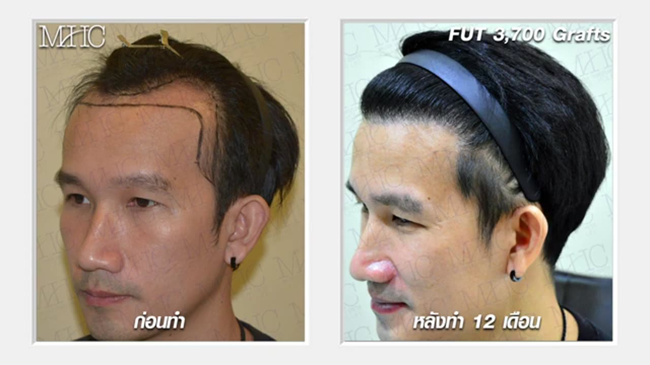 Explore the Wonders of Hair Transplant at Million Hair Transplant Center