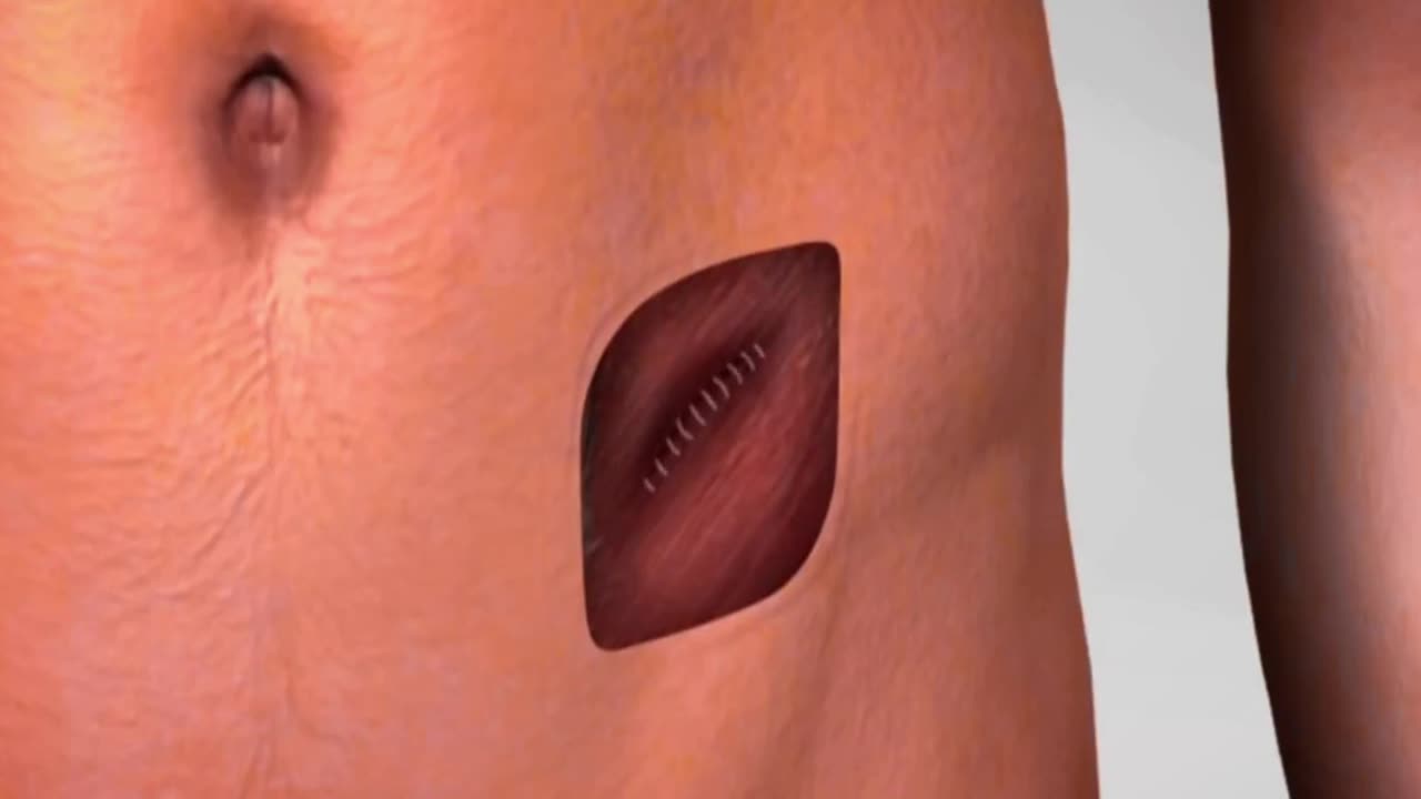 3D Animation of Hernia Repair