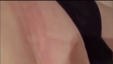 An Unusual Symptom of Advanced Morgellons.