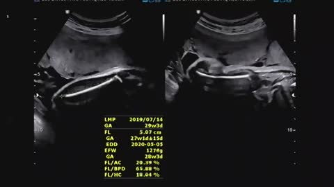 Baby ultrasound image and sound (5)