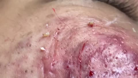 Acne Treatment Huong Da Nang# 024
