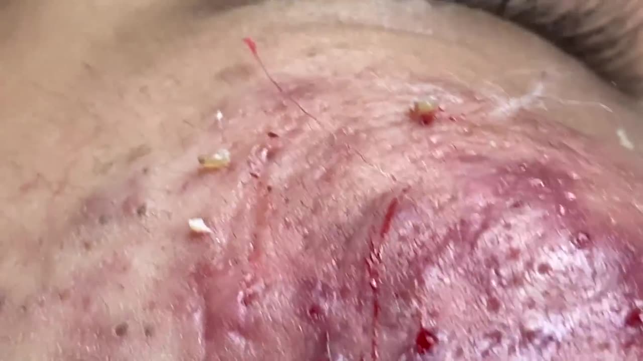 Acne Treatment Huong Da Nang# 024