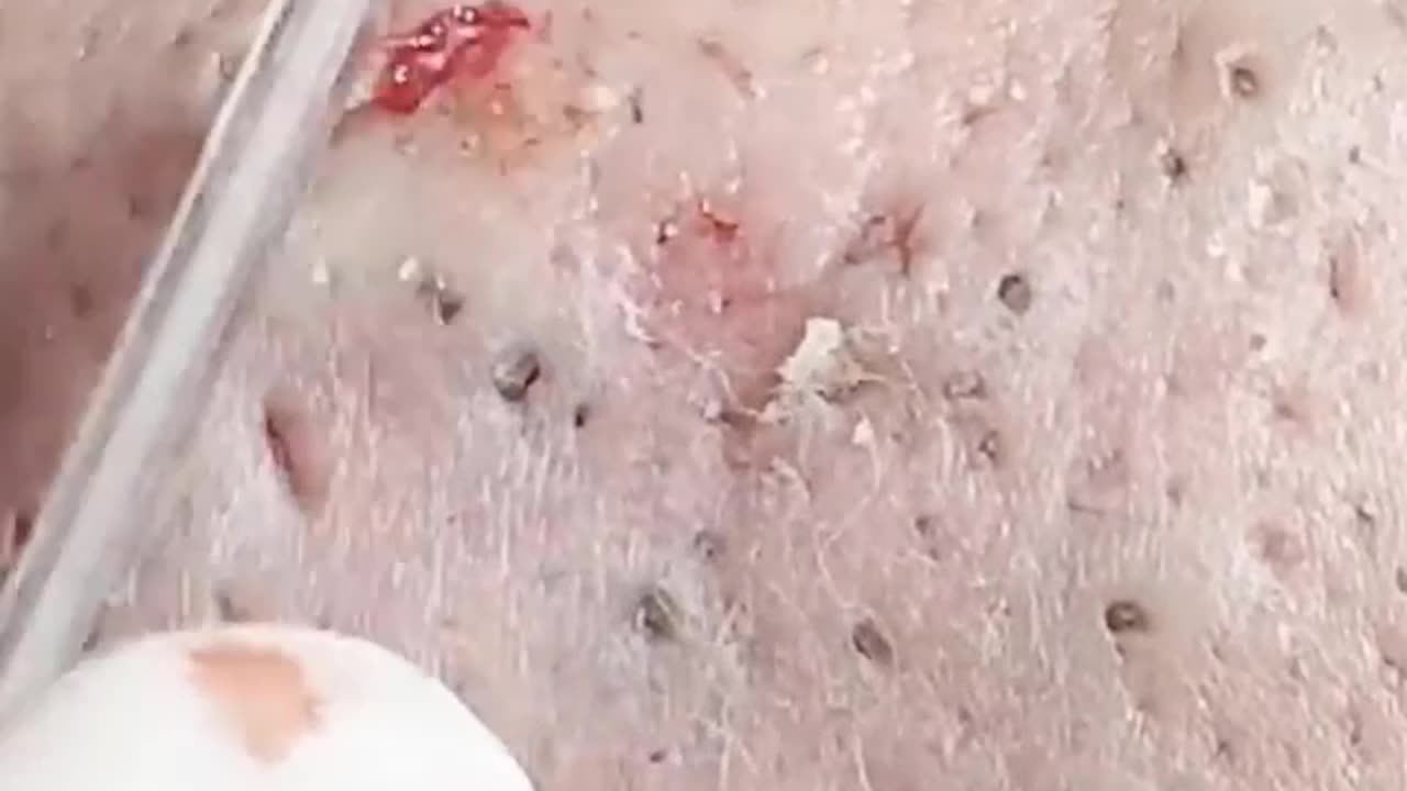 pimple popping