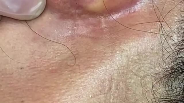 Extraction of the day