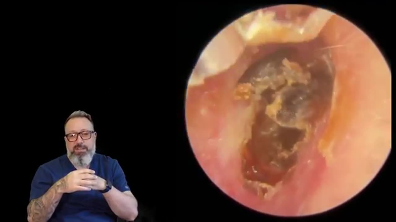 SO MUCH SKIN REMOVED FROM PATIENTS EAR CANAL - EP6