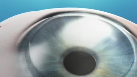 Eye Lasic Surgery