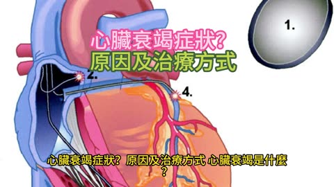 心臟衰竭症狀？ 原因及治療方式