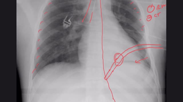 CXR for ETT placement. Right mainstem