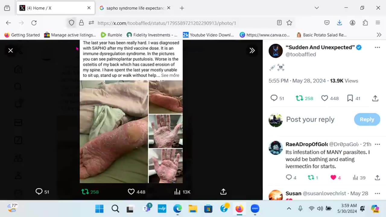 SAPHO Skin Disease After 3rd Dose of Vaccine - Don't Take Vaccines