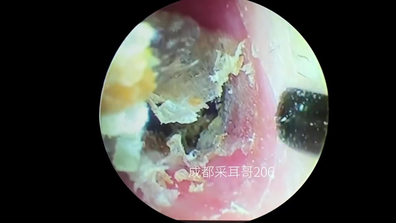 EXTREMELY SATISFYING EAR WAX REMOVAL (ASMR)